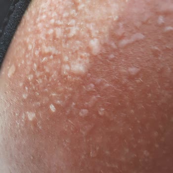 Eda Taşpınar Kremleri Yüzünden 2. Derece Yanık Oldum