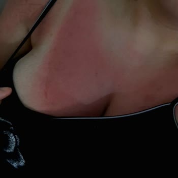 Eda Taşpınar Kremleri Yüzünden 2. Derece Yanık Oldum