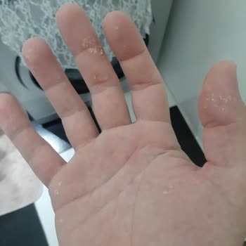 Head&Shoulders Şampuan Hatası Sac Derim Ellerim Ve Kulaklarımın Arkası Yara Oldu