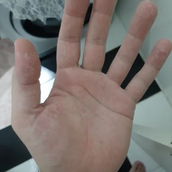 Head&Shoulders Şampuan Hatası Sac Derim Ellerim Ve Kulaklarımın Arkası Yara Oldu