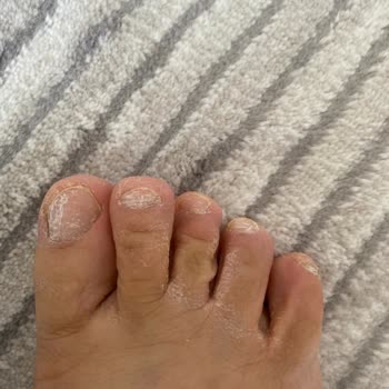 MediNail Ayak Ve Tırnak Spreyi Medinail Sprey Mantarı