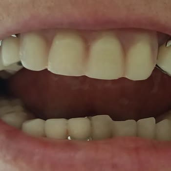 Tokat Ağız Ve Diş Sağlığı Merkezi'nde Takma Dişleri Çok Kötü Yaptılar