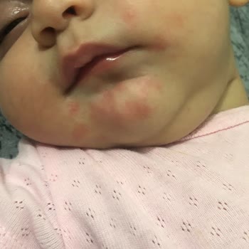 Bebelac Gold 1 Numara Yüzde Alerji Yapıyor