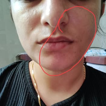 Loreal Paris L'Oreal Paris Yüz Yıkama Jeli Yüzümü Yaktı