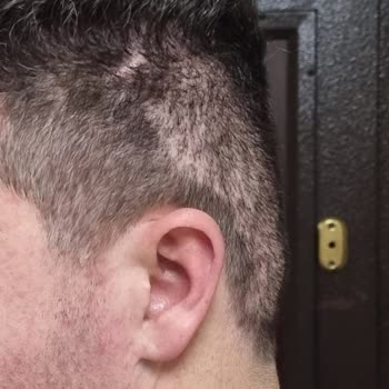 Arenamed Saç Ekiminde Sorun