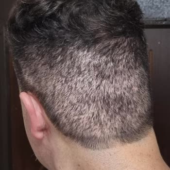 Arenamed Saç Ekiminde Sorun