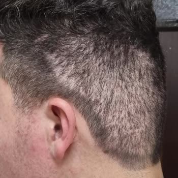 Arenamed Saç Ekiminde Sorun