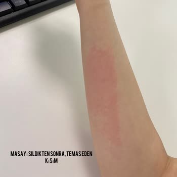 Eczacıbaşı İlaç Pazarlama Eczacıbaşı'na Ait Solo Islak Mendil' İn Alerji Yapması!