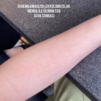 Eczacıbaşı İlaç Pazarlama Eczacıbaşı'na Ait Solo Islak Mendil' İn Alerji Yapması!