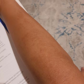 Sesu Ağla Kolumda Yanık Lekesi Oluşturdu