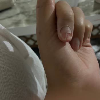 Gratis Kalıcı Oje Yazıldı Ve Tırnağım Enfekte Oldu