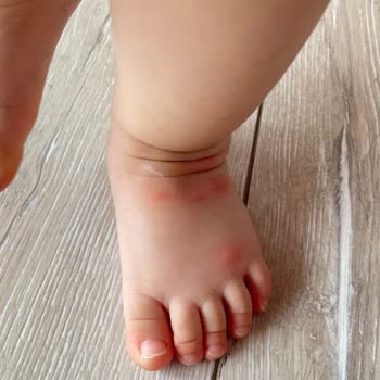 Raid Sivrisinek İlacı İşe Yaramıyor