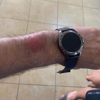 Wesse Watches Saat Isınarak Kolumu Yaktı