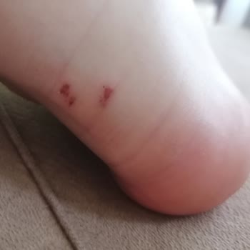 Puma Ayakkabı Yara Yaptı