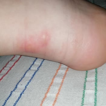 Puma Ayakkabı Yara Yaptı