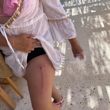 Felix Beach Marmaris Felix Beach Bodrum İhmalkarlık Yaralanması!