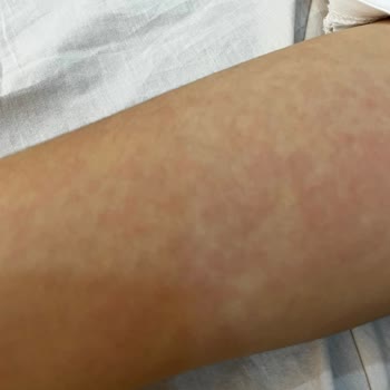 Argivit Çocuğumda Alerji Yaptı