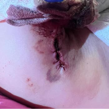 Taş Hospital Ameliyatı Beni Mağdur Etti