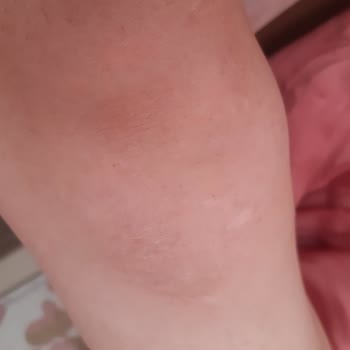 Viranşehir Aris Güzellik Merkezi Yüzünden Diz Kapaklarım Yandı