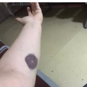 Dr. Siyami Ersek Göğüs Kalp Ve Damar Cerrahisi Eğitim Ve Araştırma Hastanesi Damarımı Çatlattı