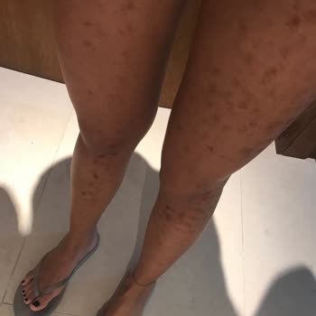 Ankara Cerrahi Tıp Merkezi Güzellik Merkezi Çalışanı Bacaklarımı Yaktı