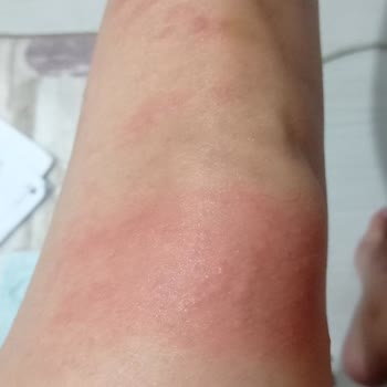 Q Zen Beauty Lazer Epilasyon Tam Bir Fiyasko