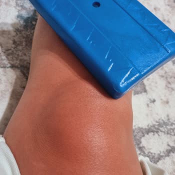 Cire Aseptine Güneş Kreminden Kaynaklanan Güneş Yanığı.