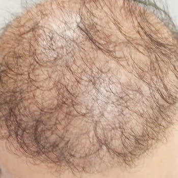 Op. Dr. Mustafa Karakaş Saç Ekimi!