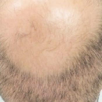 Op. Dr. Mustafa Karakaş Saç Ekimi!