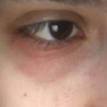 The Purest Solutions Gözaltı İçin The Purest Kullandım Gözümün Altı Kızardı Şişti Mahvoldu