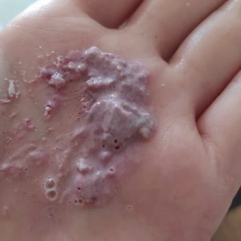 The Purest Solutions Enzim Peeling Ürünüm Bozuldu