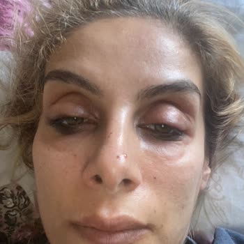 Bee Beauty Göz Temizleme Ürünü Ve Rimel Kullanımı Sonucu Oluşan Reaksiyon