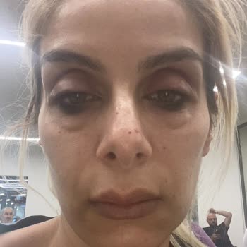 Bee Beauty Göz Temizleme Ürünü Ve Rimel Kullanımı Sonucu Oluşan Reaksiyon