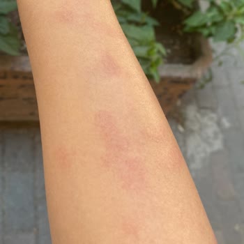 Uzm. Est. Buse Topçuoğlu Lazerde Yanık Oluştu