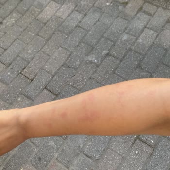 Uzm. Est. Buse Topçuoğlu Lazerde Yanık Oluştu