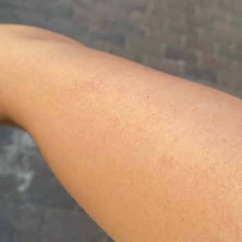 Uzm. Est. Buse Topçuoğlu Lazerde Yanık Oluştu