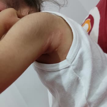 Argivit Ürtiker Kaşıntı Şişlik