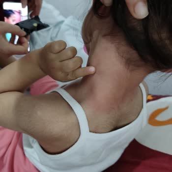 Argivit Ürtiker Kaşıntı Şişlik