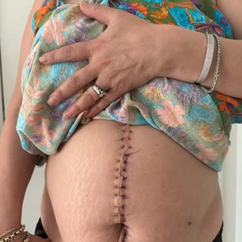 Op. Dr. Özden Avcı Mide Balonu Ve Bot Mide Kanaması Ölümden Döndüm