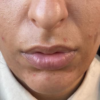 La Roche - Posay Effaclar Duo Yüz Yıkama Jeli Ve Tonic Kullanımı Sonrası Deneyimim