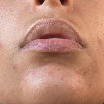 La Roche - Posay Effaclar Duo Yüz Yıkama Jeli Ve Tonic Kullanımı Sonrası Deneyimim