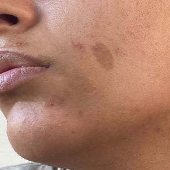 La Roche - Posay Effaclar Duo Yüz Yıkama Jeli Ve Tonic Kullanımı Sonrası Deneyimim