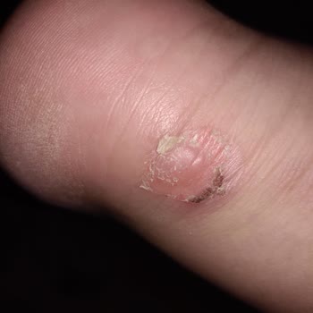 Nike Ayakkabının Ayağımı Yara Yapması