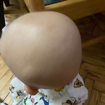 Acıbadem Hastanesi Kafasına Darbe Alan Bebeğim