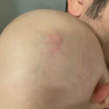 Acıbadem Hastanesi Kafasına Darbe Alan Bebeğim