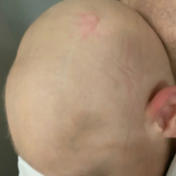 Acıbadem Hastanesi Kafasına Darbe Alan Bebeğim