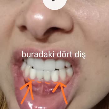 Postmodern Ağız Ve Diş Sağlığı Polikliniği Zirkonyum Diş Tedavisi