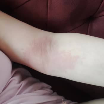 Sağlık Bakanlığı Arnavut Kremi Ve Gösterdiği Alerjen Reaksiyon