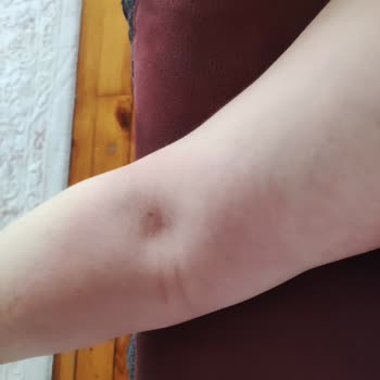 Sağlık Bakanlığı Arnavut Kremi Ve Gösterdiği Alerjen Reaksiyon