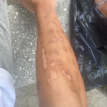 Deva Güzellik Ve Lazer Merkezi Lazer Epilasyonu Yanağı